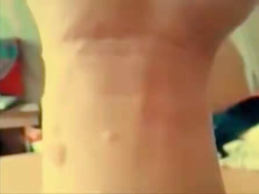 男子手长满树疙瘩是什么病,男子手长满树疙瘩手术了吗