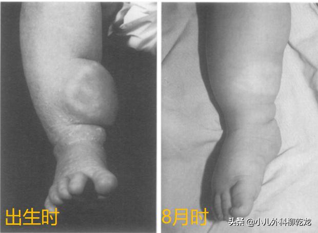 刚出生孩子肿瘤,刚出生长肿瘤