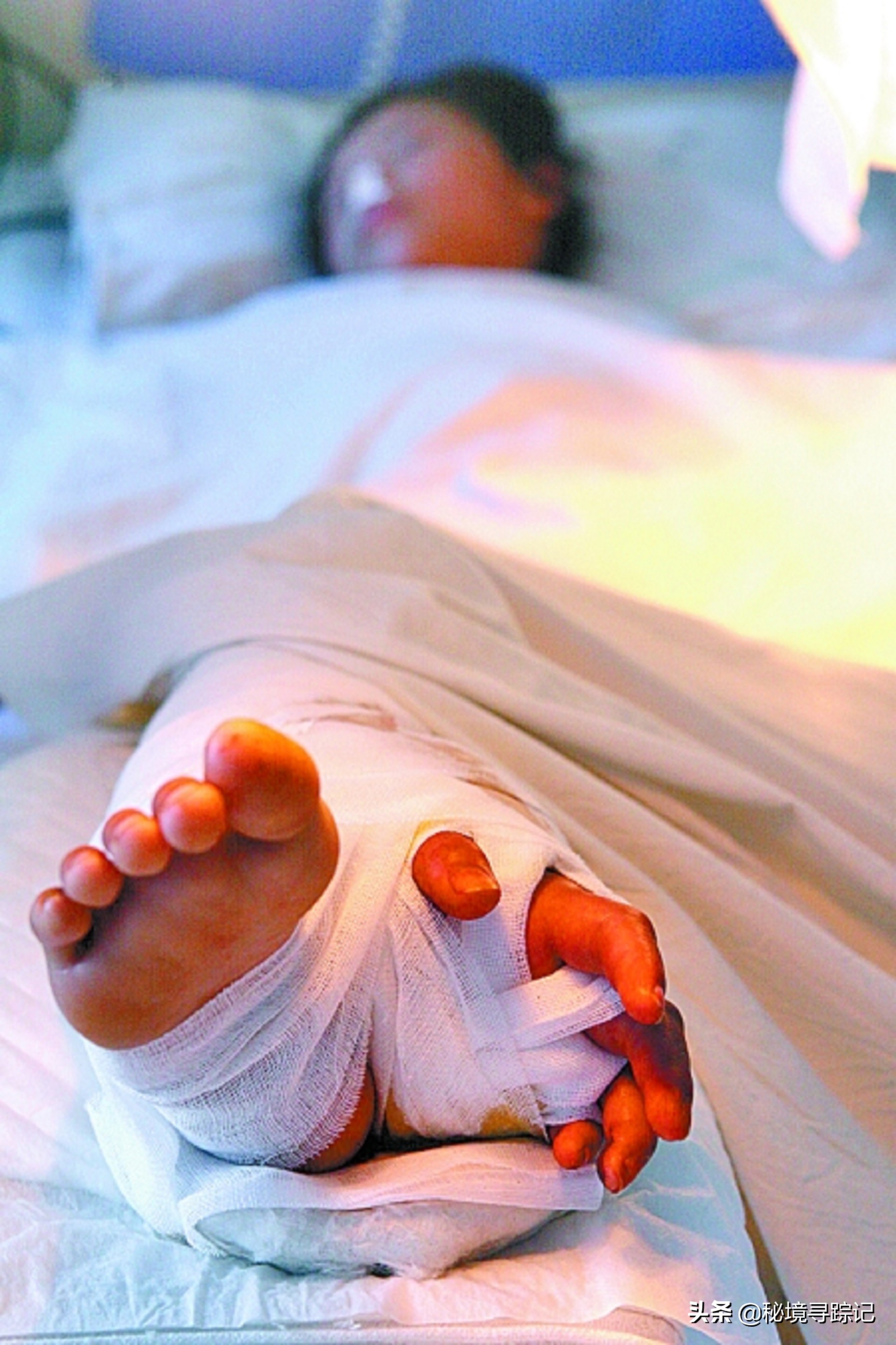 儿童胳膊断了做手术,小孩手臂断了真实手术