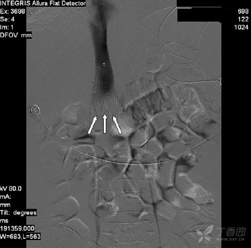 女性腹部突发疼痛怎么回事,女性65岁突然下腹疼有出血怎么了