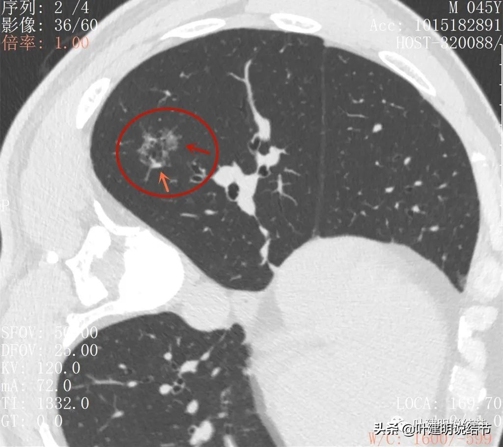 肺蜂窝状改变是肺癌吗,肺部陈旧灶与肿瘤怎么确诊