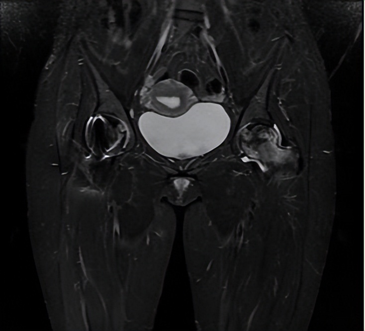 冲击波治疗股骨头坏死后拄拐吗,股骨头坏死钻孔减压要拄拐多久