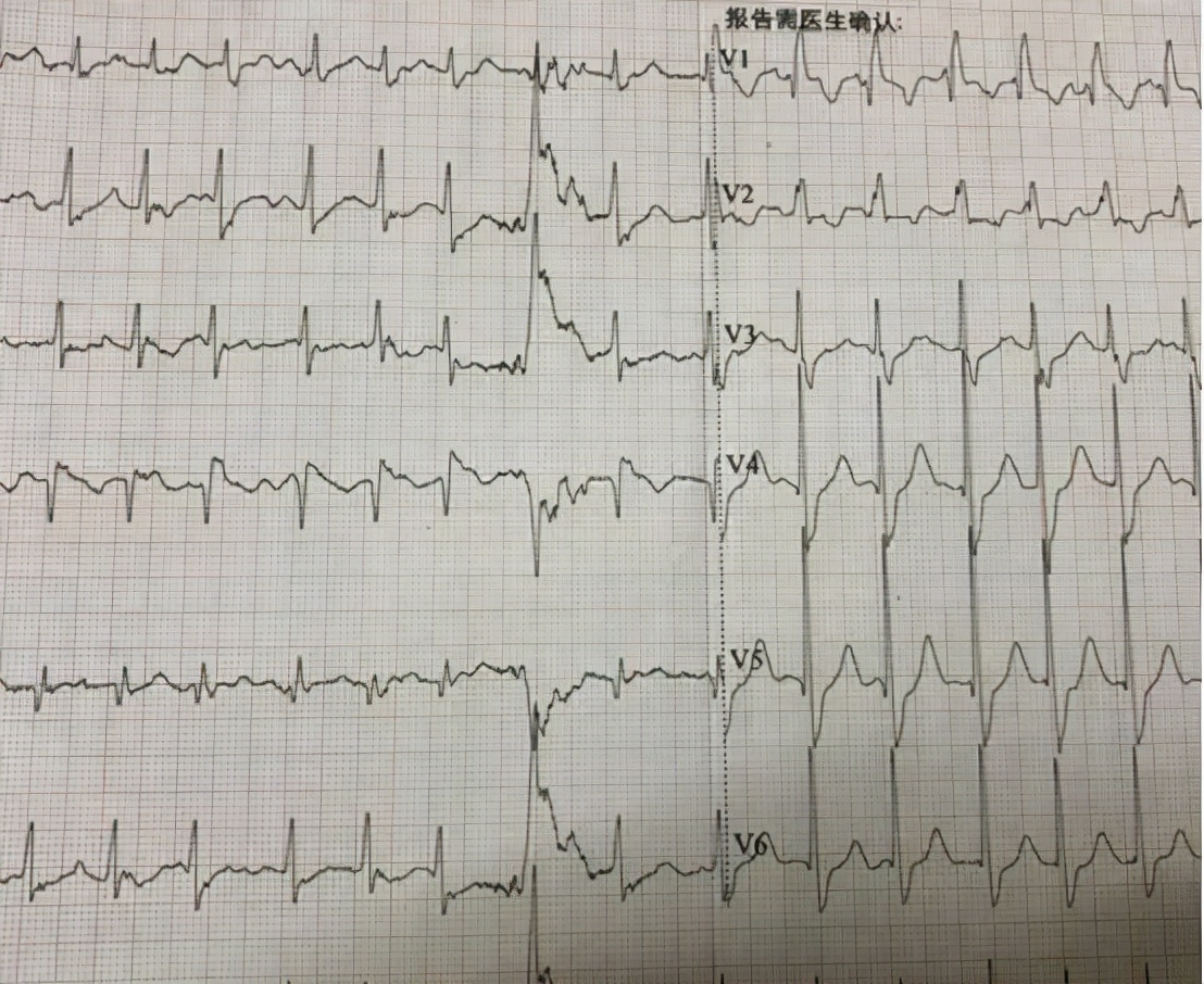 国产降压新药阿利沙坦酯,降压药阿利沙坦酯片的副作用