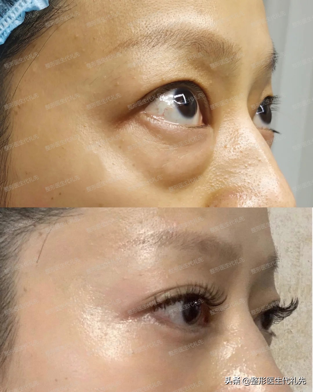 脂肪型眼袋伴有泪沟怎么办,眶隔脂肪释放去眼袋是怎么回事