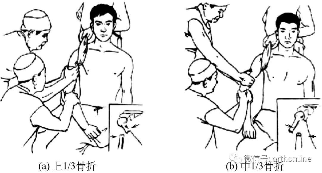 股骨干骨折保守治疗多久恢复,肱骨干骨折恢复过程中的四大禁忌