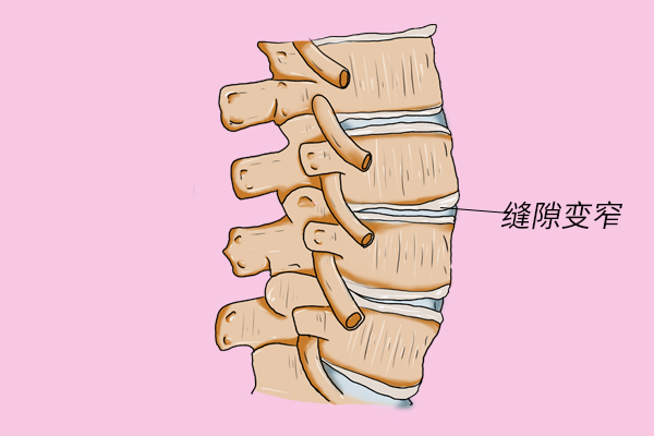 颈椎腰椎多处突出是什么原因,颈椎突出腰椎突出怎么治疗