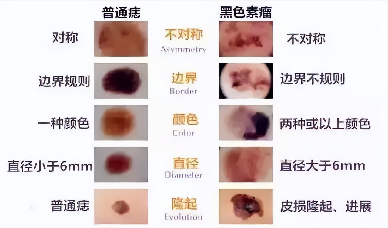 痣提前弄掉会导致黑色素瘤吗,痣和黑色素瘤哪个可以抠掉
