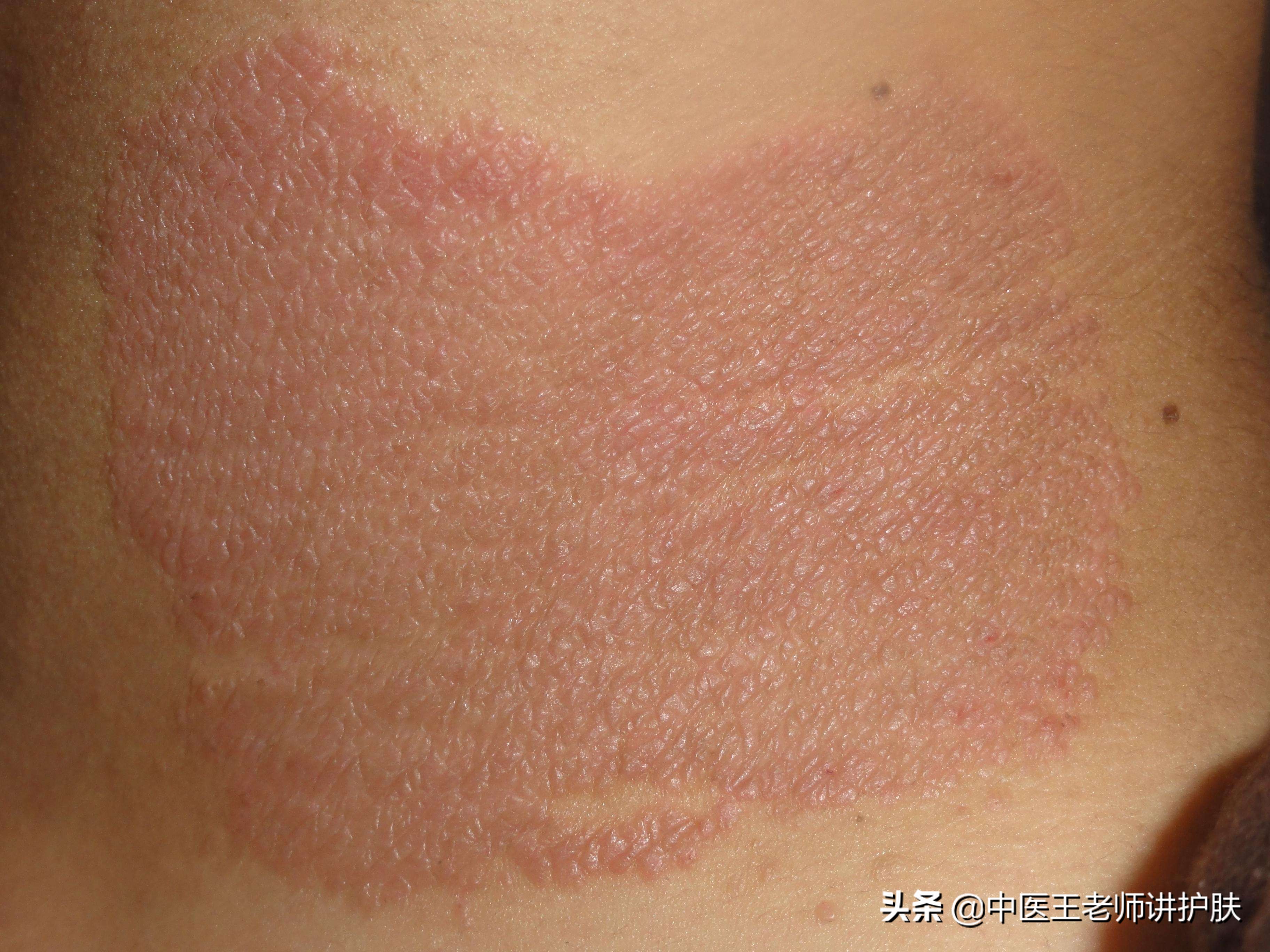 澶栨劅椋庣嚗澶寸櫍鎬庝箞璋冪悊,鐤忚倽鐞嗘皵绁涢閭殑涓嵂