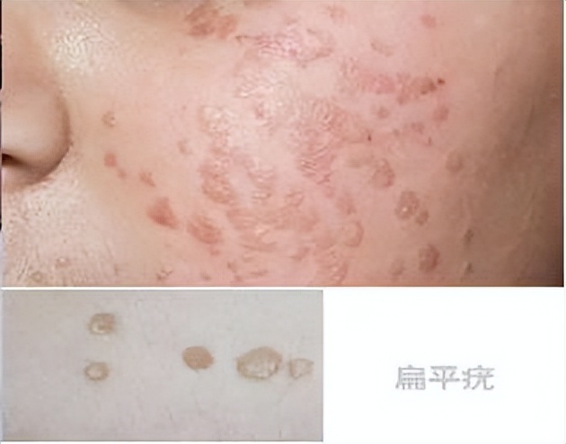 脸上有上百个扁平疣怎么治,脖子脸身上都有扁平疣该怎么治疗