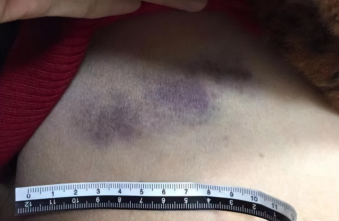 女子整容失败索赔被打视频,女子整形失败成植物人获赔360万元