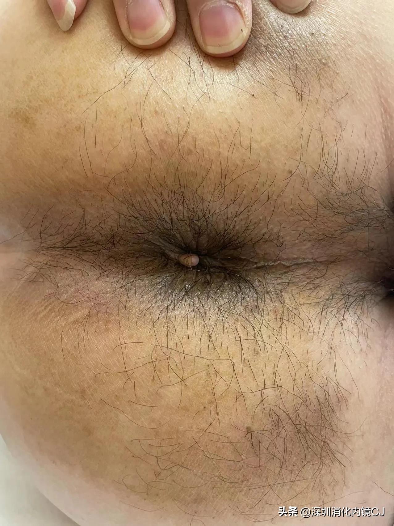 iii型痔疮,哪些痔疮患者适合内镜下套扎治疗