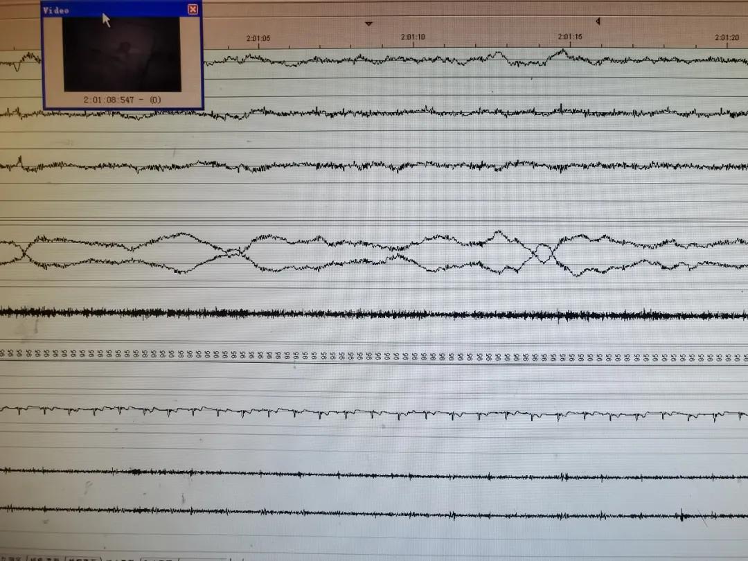 治疗打鼾需要去医院睡一觉吗,打鼾是一种病吗视频