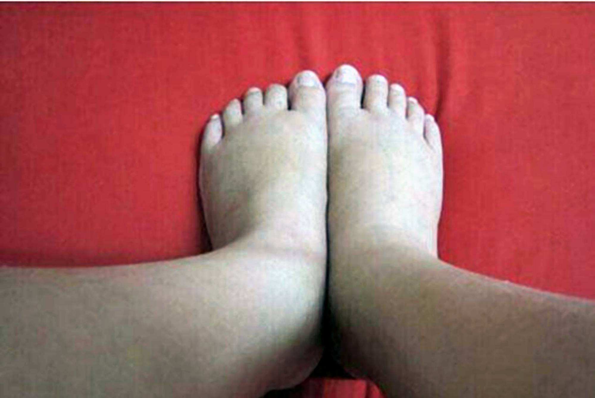 便宜好用的四妙丸，不仅清热利湿，还可适用于这5种病