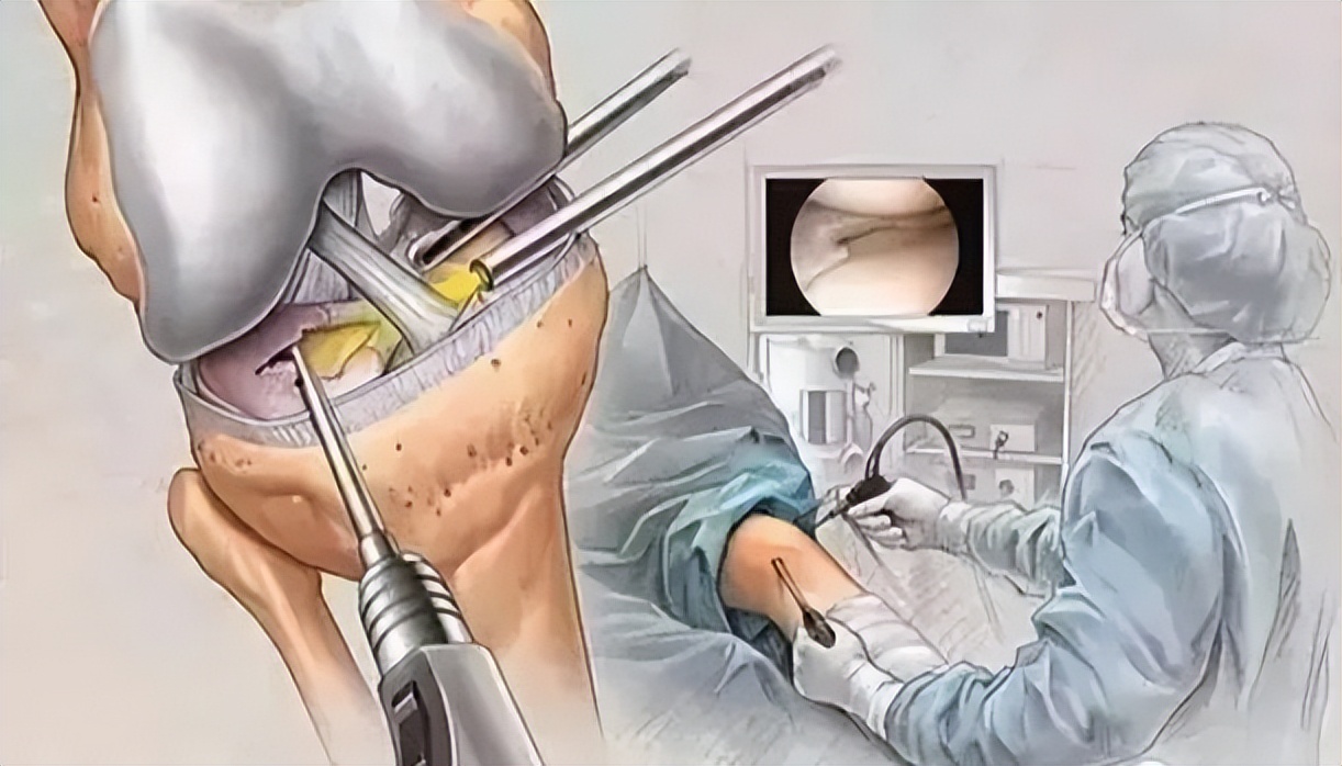关节镜微创小手术,医疗领域小切口解决大问题