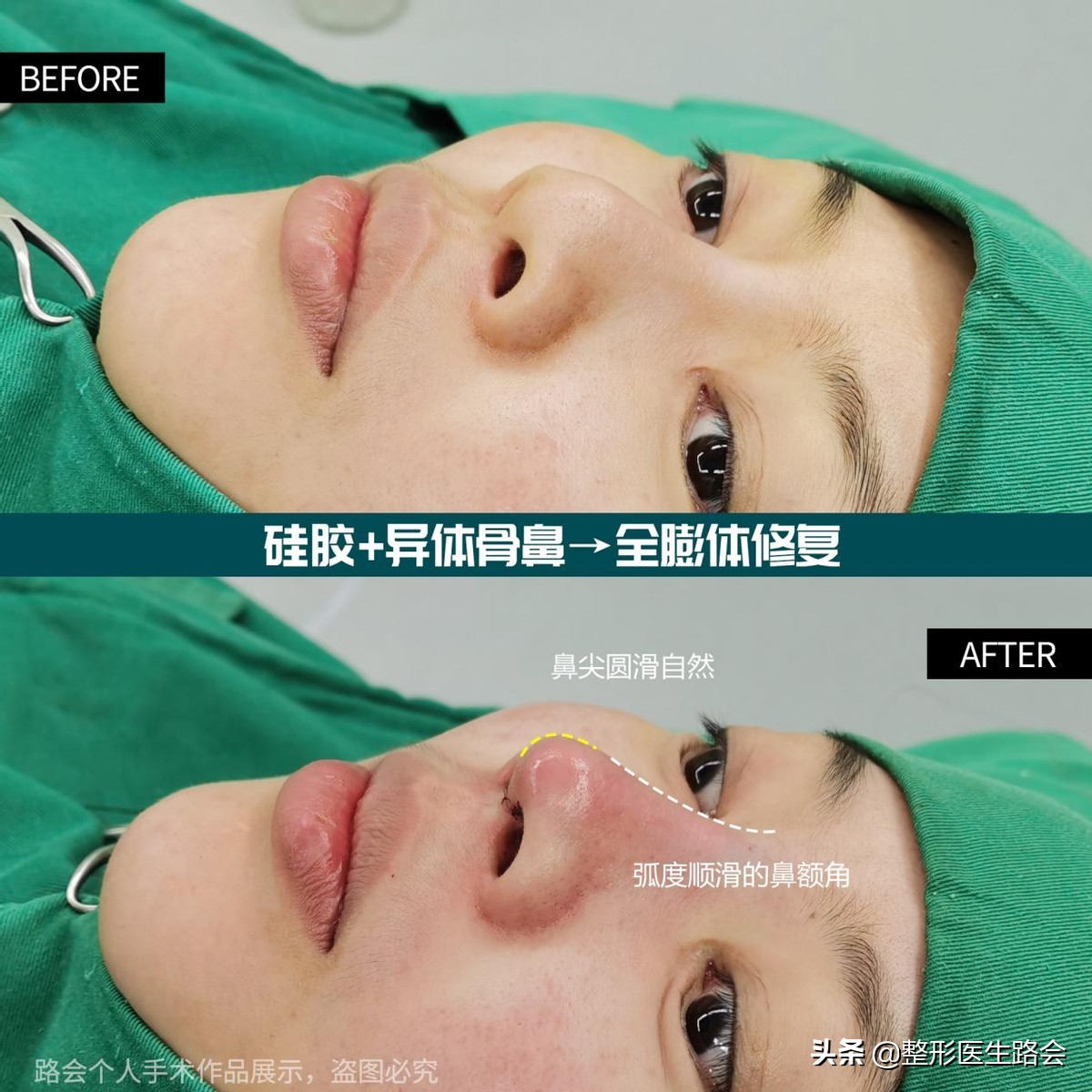 鼻子硅胶假体取出来真实感受,取出硅胶假体鼻子1-7天恢复过程图