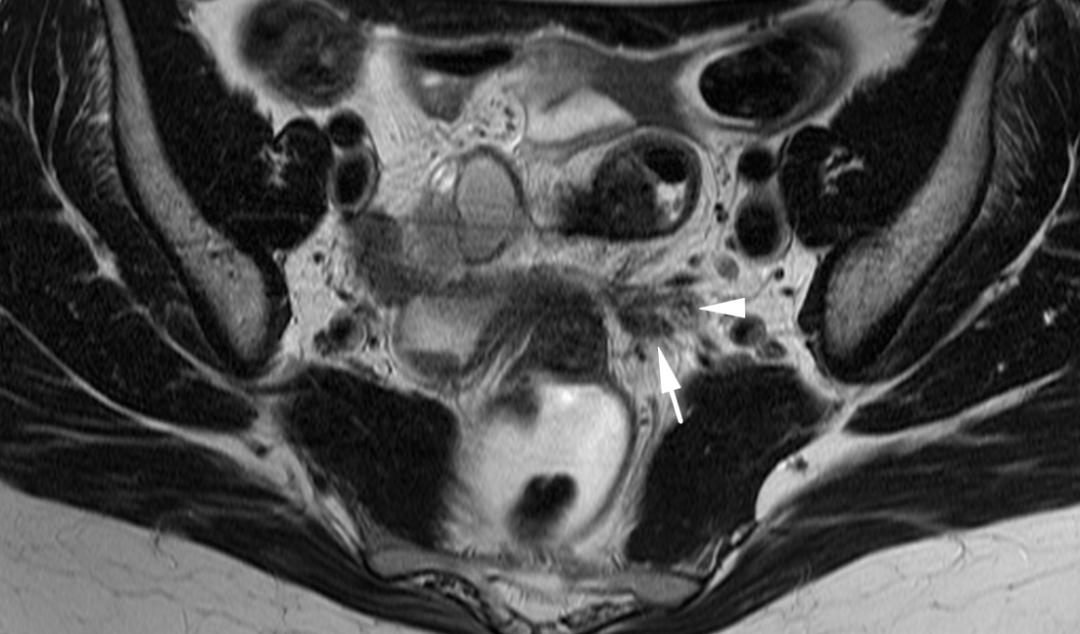 MRI如何评估子宫内膜异位症？这10个病例会帮助您