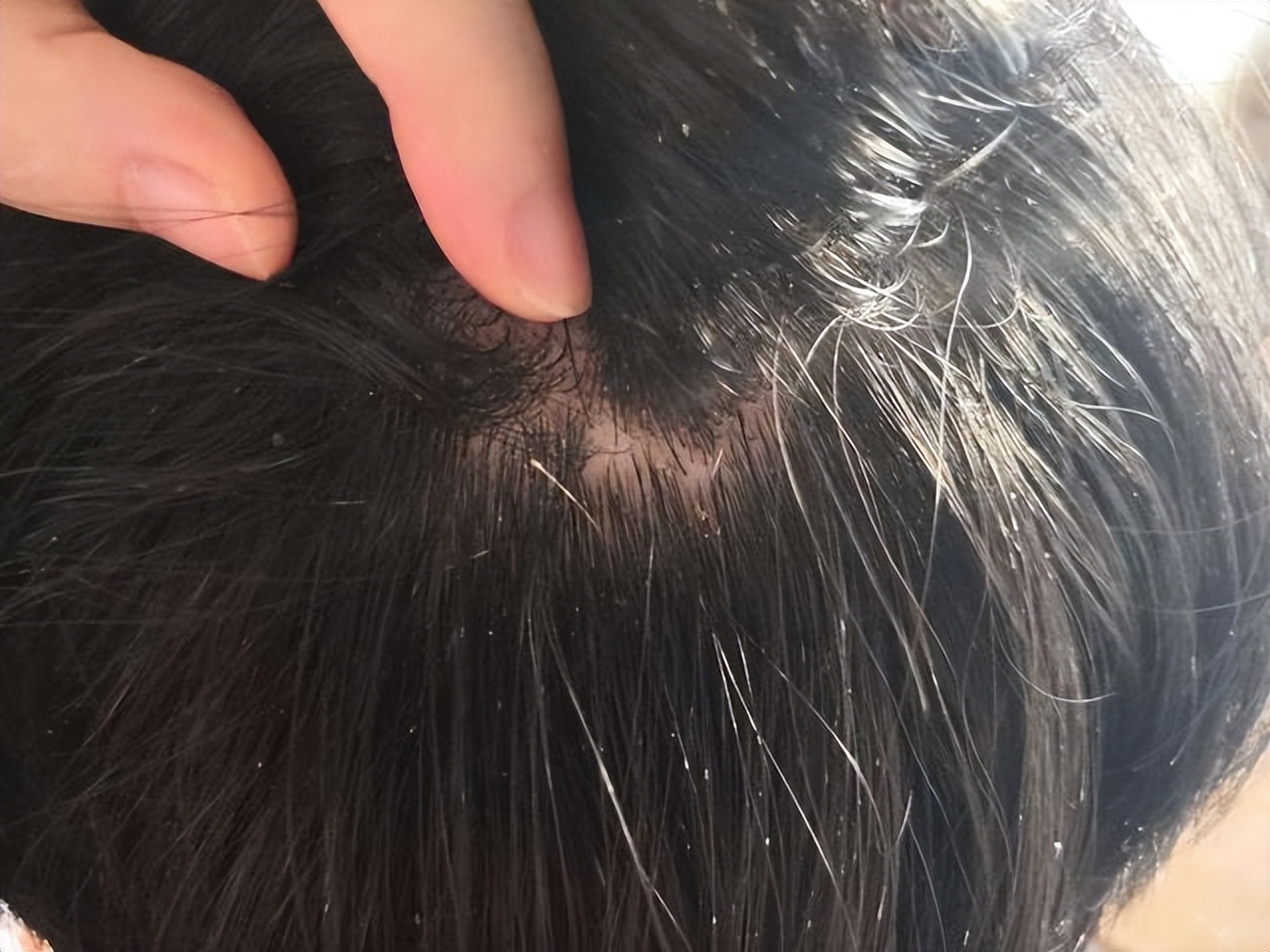 头皮总长疙瘩和脓包是怎么回事,头皮老是长疙瘩有脓包怎么办