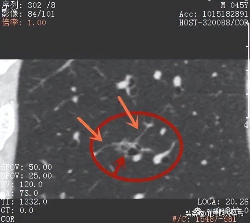 肺蜂窝状改变是肺癌吗,肺部陈旧灶与肿瘤怎么确诊