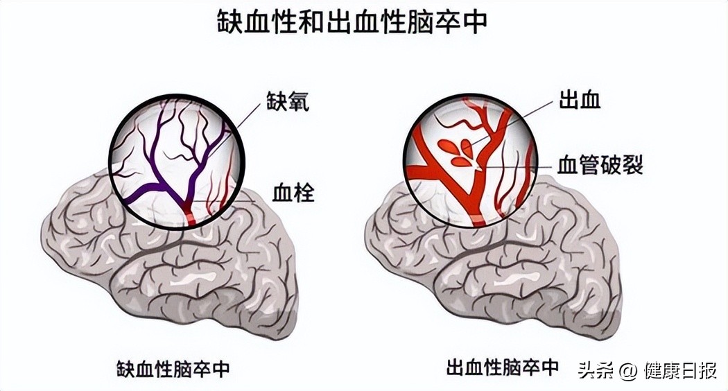 云开“雾”散联合血管重建术消弭烟雾病烦扰，专家：反复脑“中风”，可能是烟雾病放出的“烟雾弹”