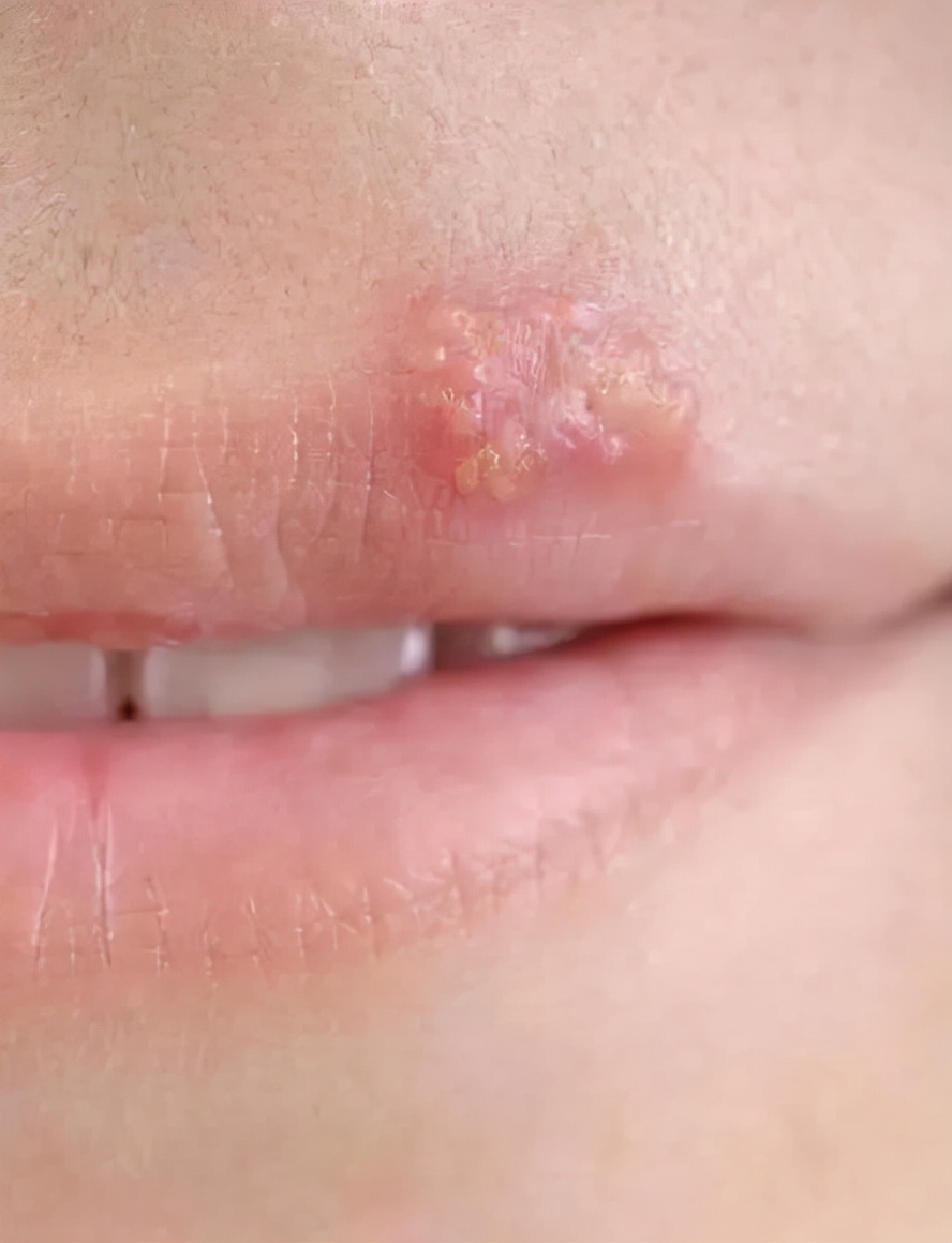 嘴角起泡口腔溃疡最快解决方法,经常口腔溃疡嘴角起泡是什么原因