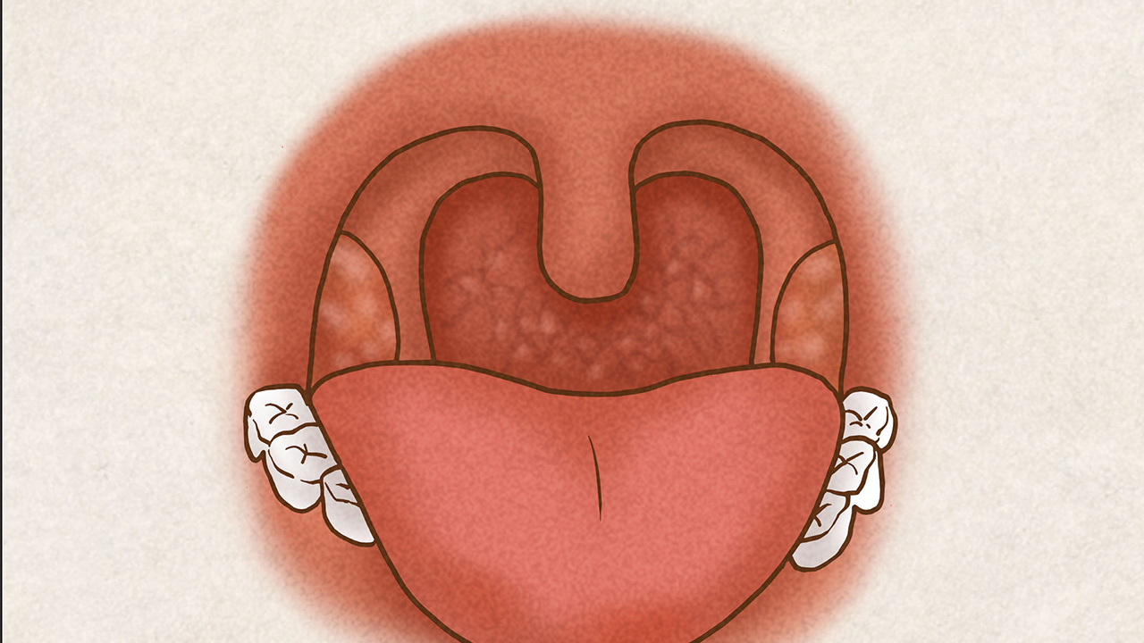 咽喉有痰怎么快速止咳化痰,喉咙有痰咳不出咽不下小妙招中医