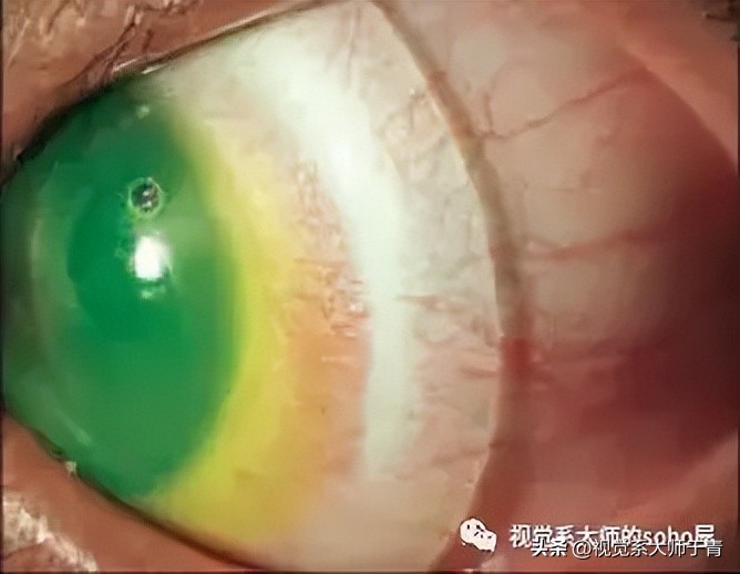 巩膜镜的验配技巧及案例分享,试戴巩膜镜成功率高不高