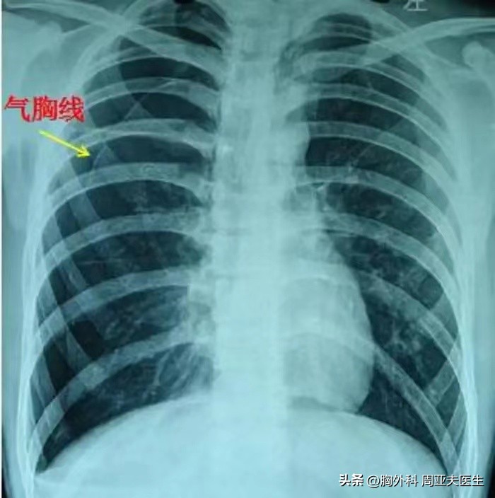 关于气胸的讨论,关于气胸