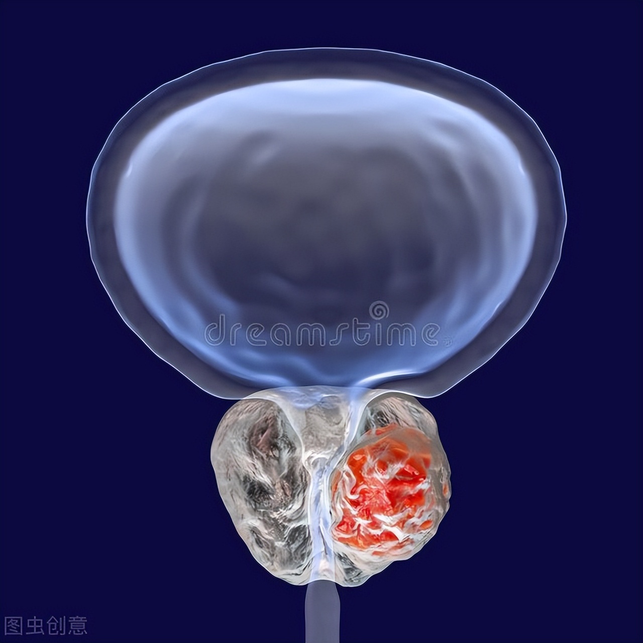 前列腺肥大应注意些什么,前列腺增生肥大术后的注意事项