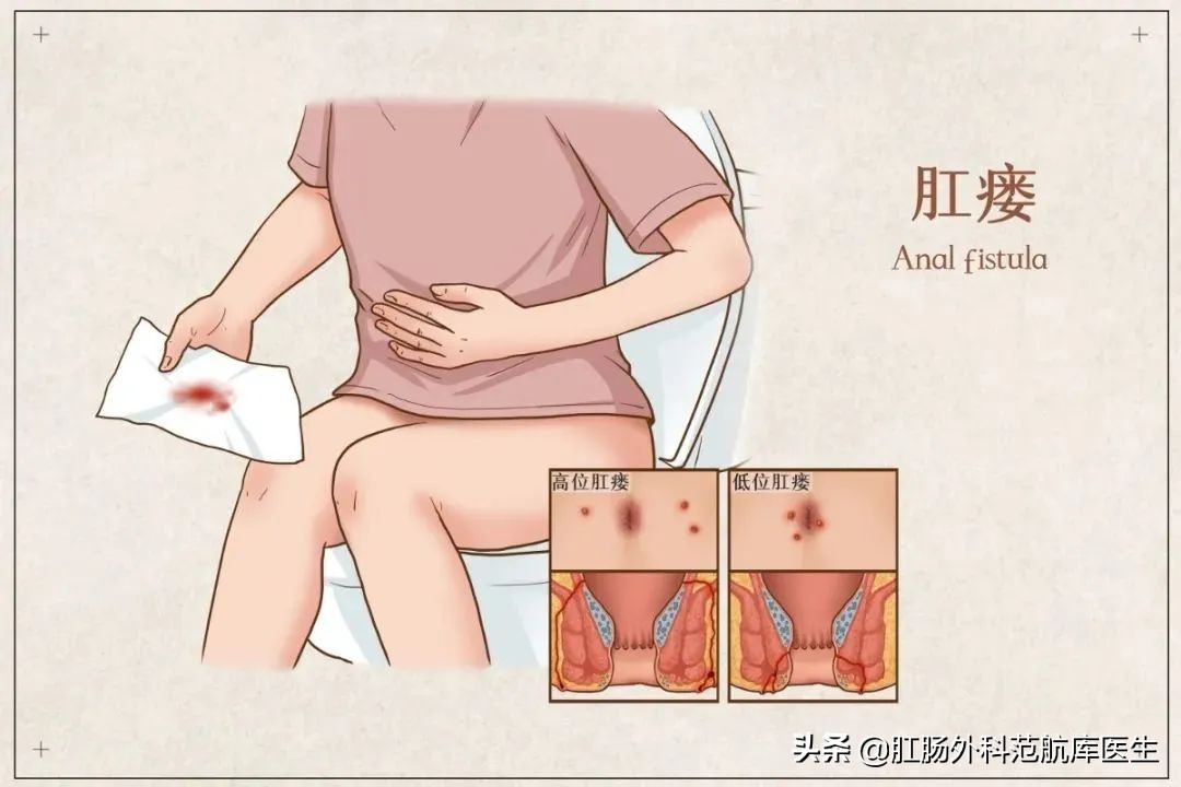 复杂性高位肛瘘微创手术