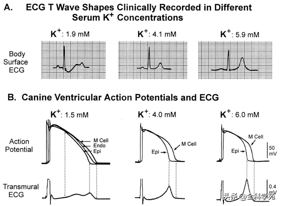 t波高尖心电图判断标准,t波高尖判断标准