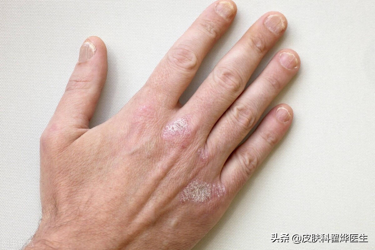 幽门螺旋杆菌与哪些皮肤病有关,幽门螺杆菌会引起皮肤病吗