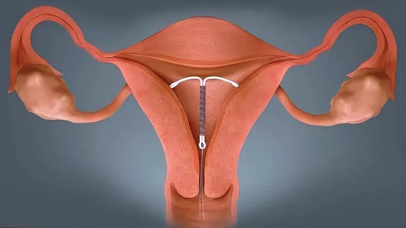 女人身体里的节育环不取出来行吗,女性身体里的节育环