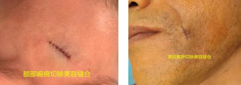 大面积外伤疤痕怎么修复,面部手术留下的蜈蚣疤痕怎么修复