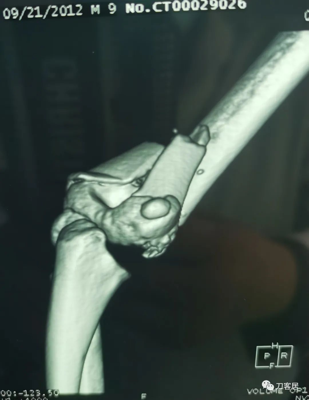 孩子胳膊摔伤肿了不能弯曲一直疼,9岁男孩摔倒手臂痛怎么办