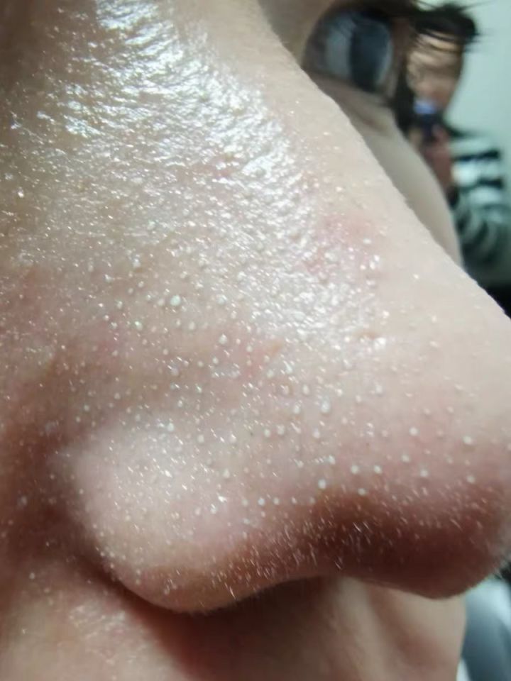 超微小气泡美容有用吗,美容院小气泡