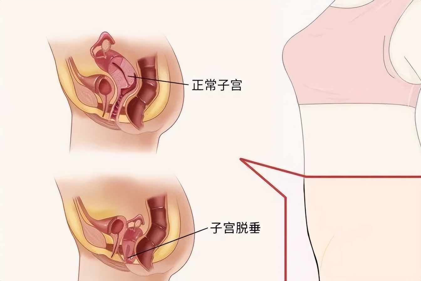 阴挺怎么调理,女性阴衰是什么原因造成的