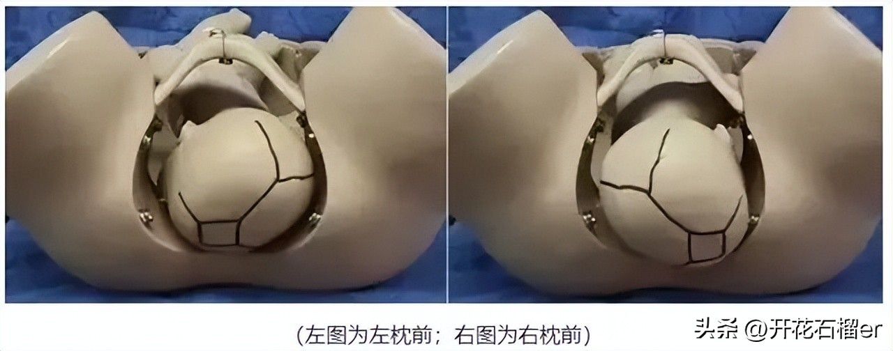 仰头和低头出生的区别,婴儿仰头出生和侧身出生