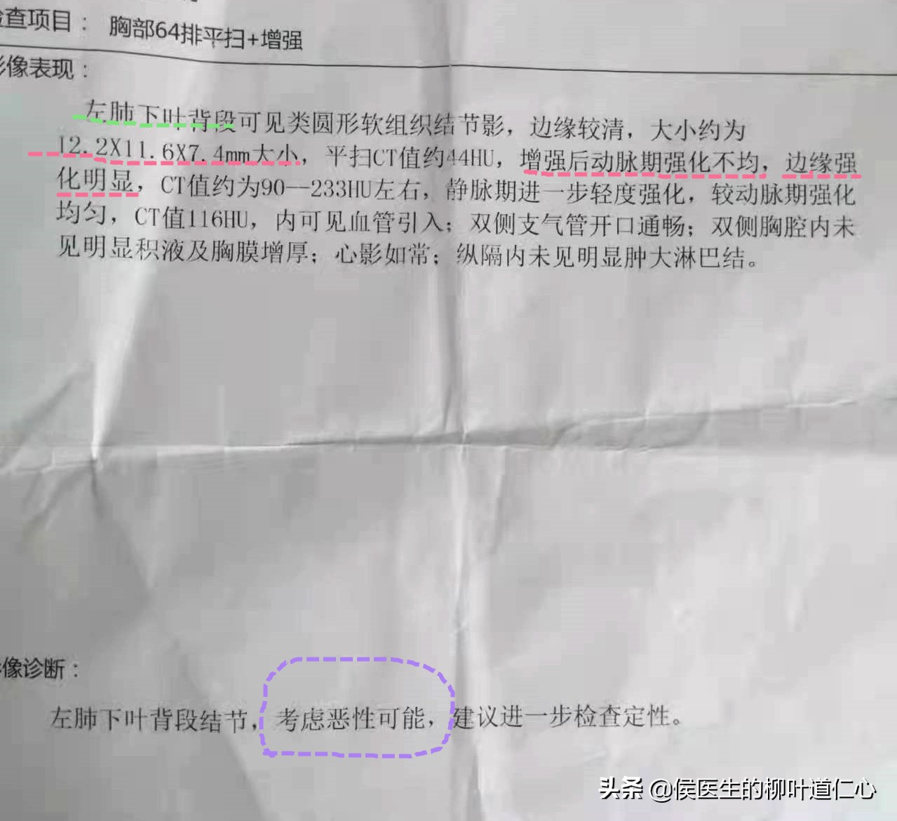 这例“被肺癌”的结节，手术不过度，但完全可以延迟在疫情后