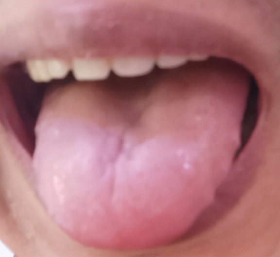 过敏性紫癜喝凉血祛风糖浆有效吗,为什么过敏性紫癜出血时间不延长