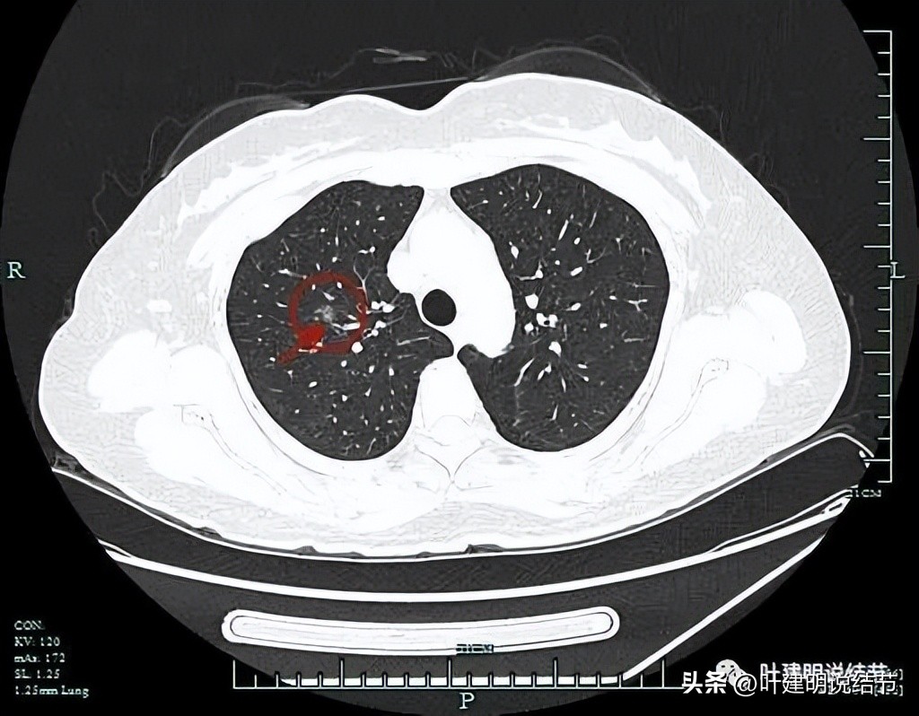 浙江肿瘤医院做肺结节手术多少钱,浙江省肿瘤医院肺结节微创手术
