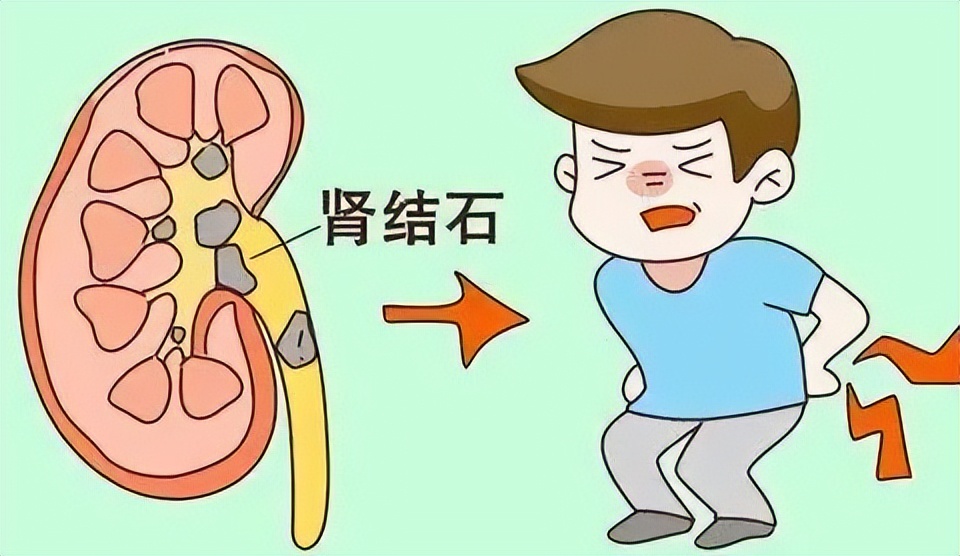肾结石引起的高血压怎么办,肾结石和高血压有关系吗