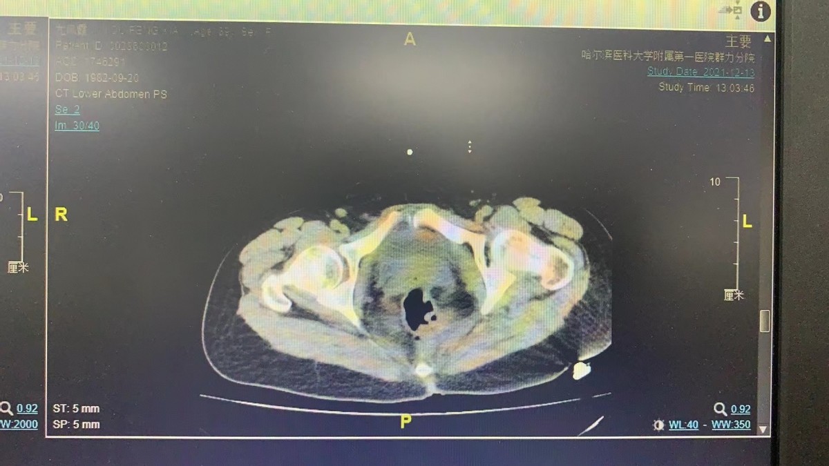 哈医大一院群力妇科成功治愈一例罕见盆腹腔多部位增生性组织细胞病