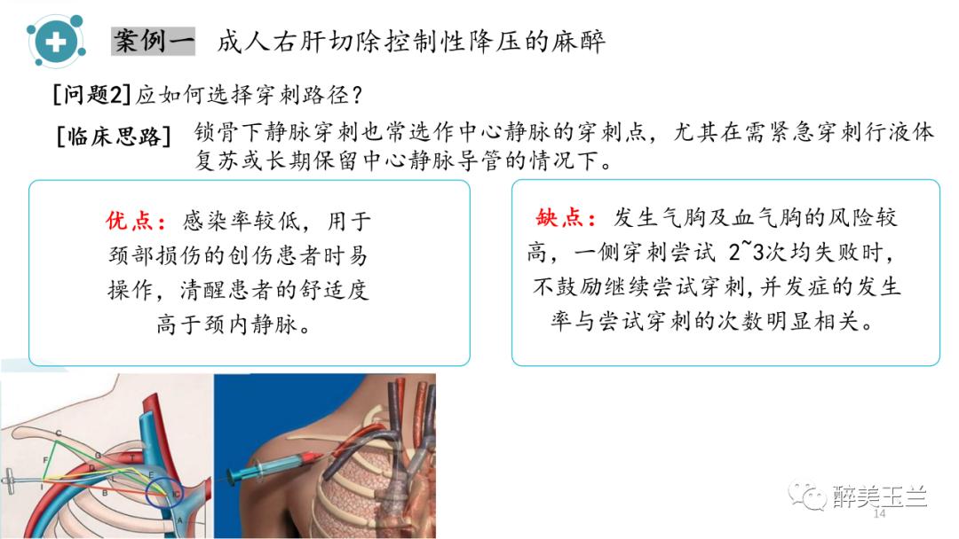 深静脉穿刺置管术讲解ppt,中心静脉穿刺置管深度