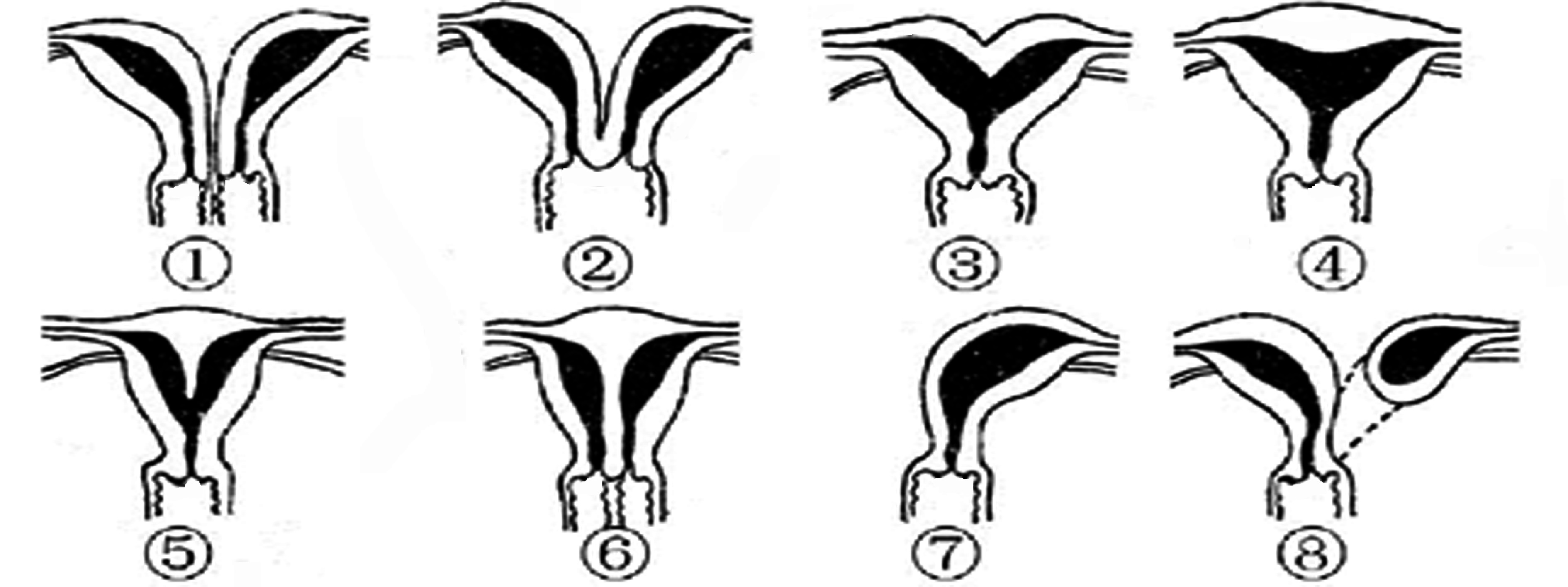 明明白白做超声33-13：双子宫妊娠