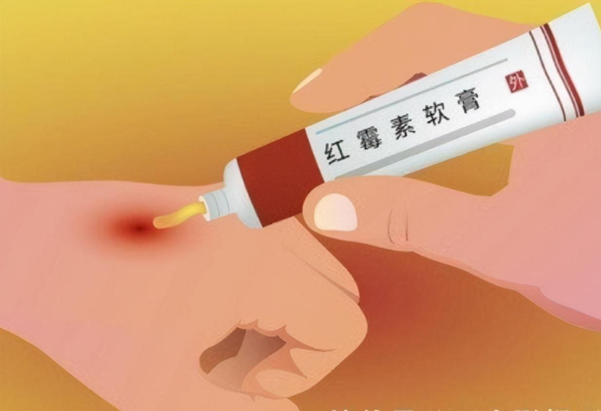 用红霉素软膏皮肤会变黑吗,用红霉素软膏擦一擦就好了