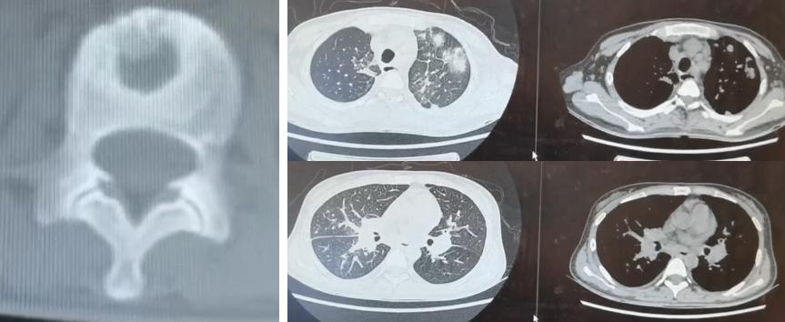 免疫缺陷病会并发什么病,什么是免疫缺陷肺部感染