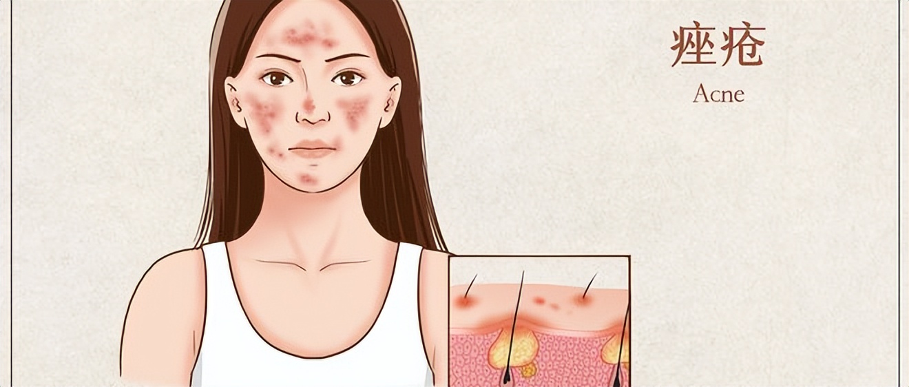 痘痘怎么护理和消除,痘痘怎么自然养好