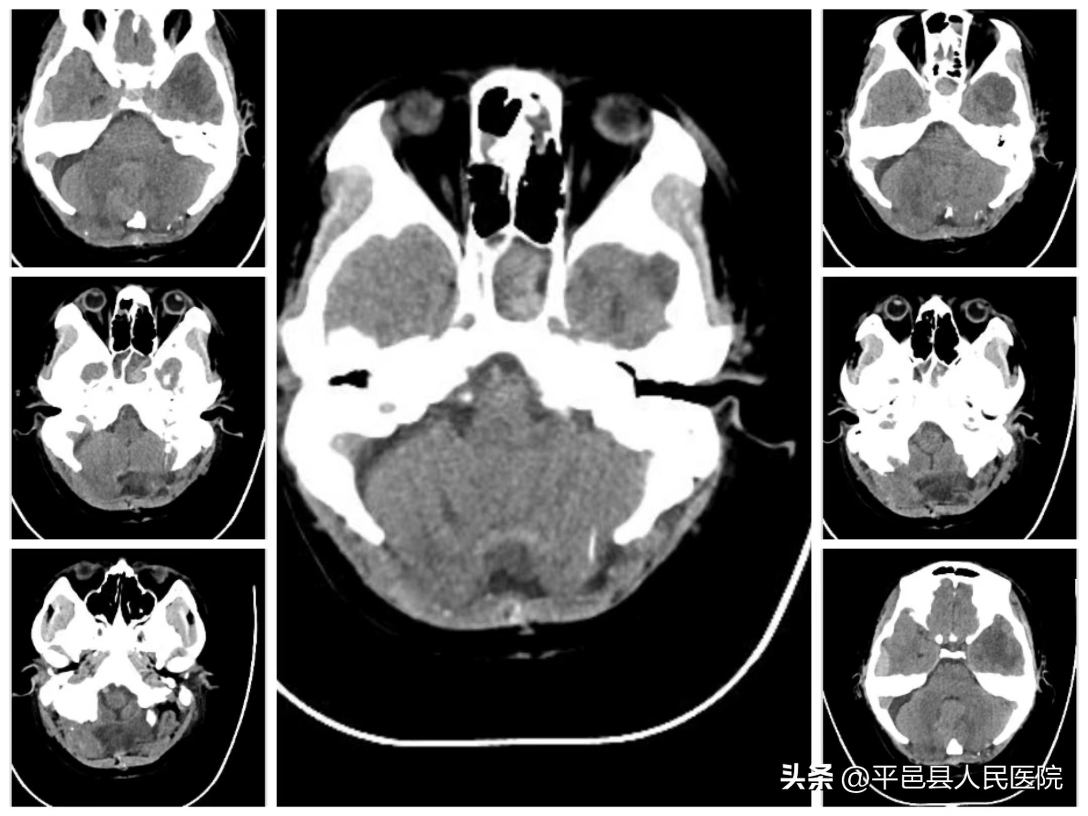 双十年华突发严重多发外伤多科协作联合手术成功救治