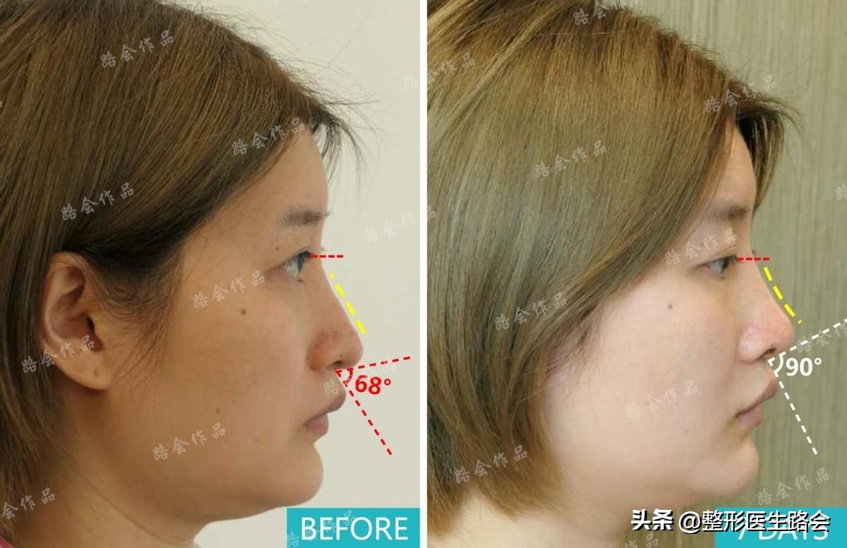 隆鼻手术全过程女生,隆鼻手术到底是怎么进行的