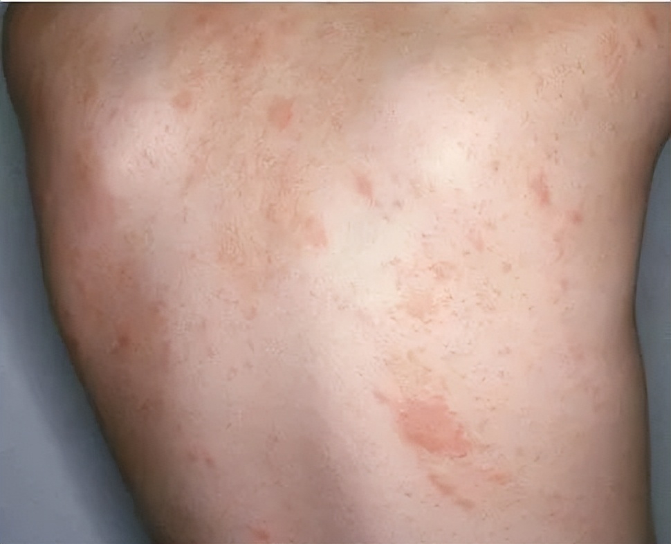 生活中最常见的4种皮肤病,皮肤科可以看多种皮肤病吗